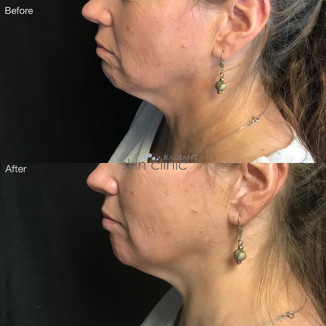 Chin Augment 2 - Radiant pic - resized