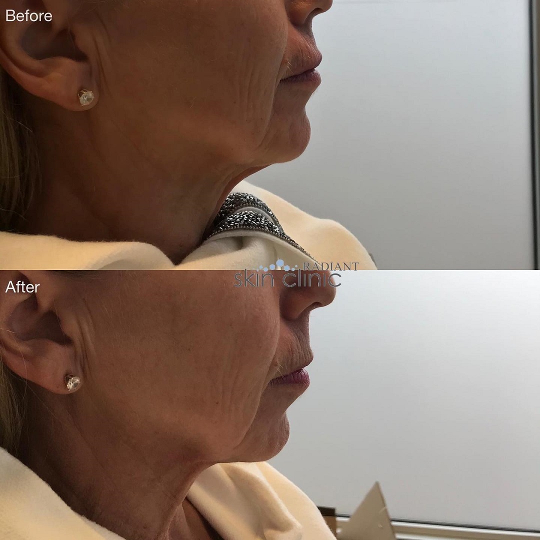 Chin Augment - Radiant pic resized