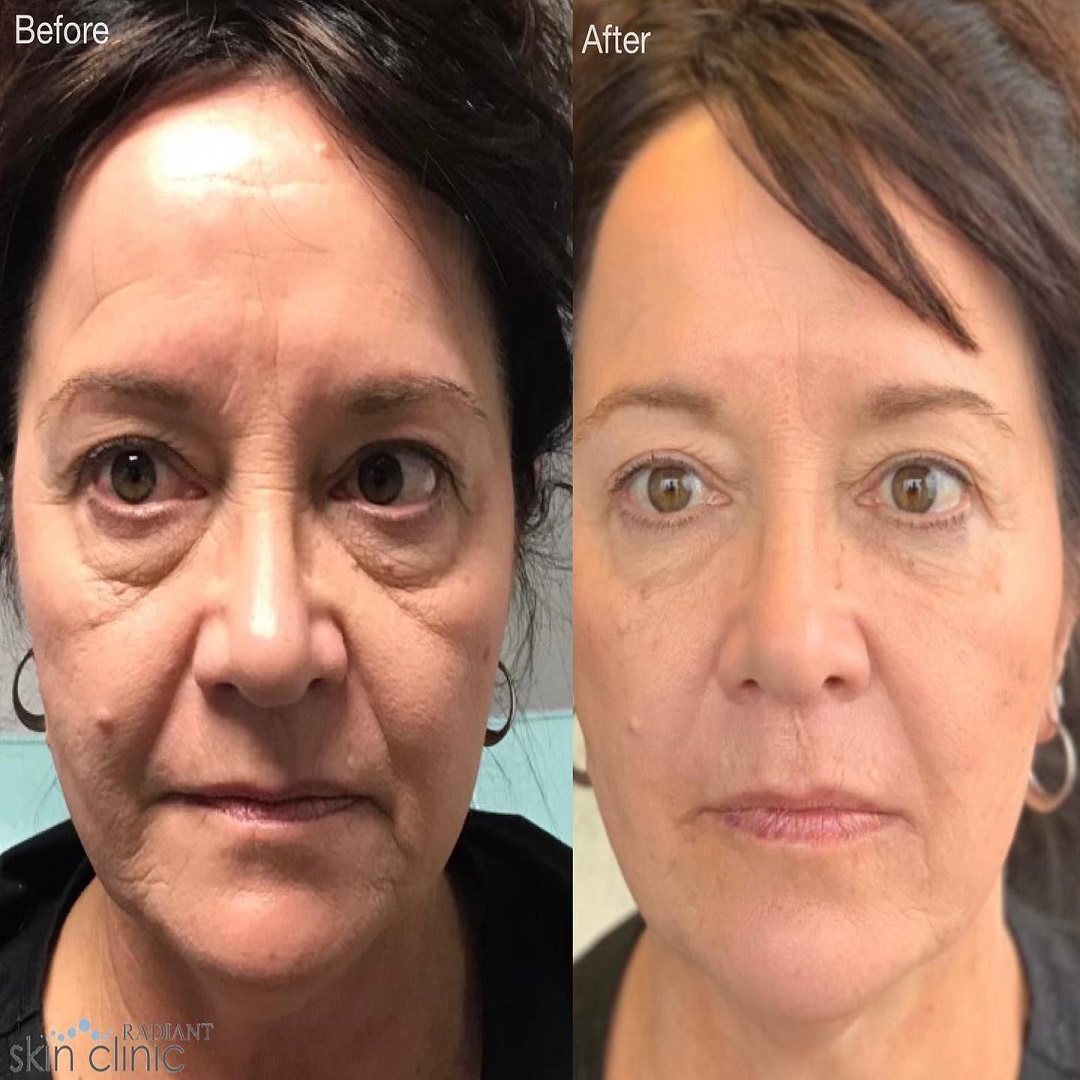 Liquid Facelift - Radiant resized