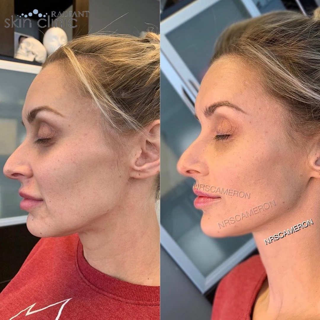 Liquid facelift 2 - Radiant resized