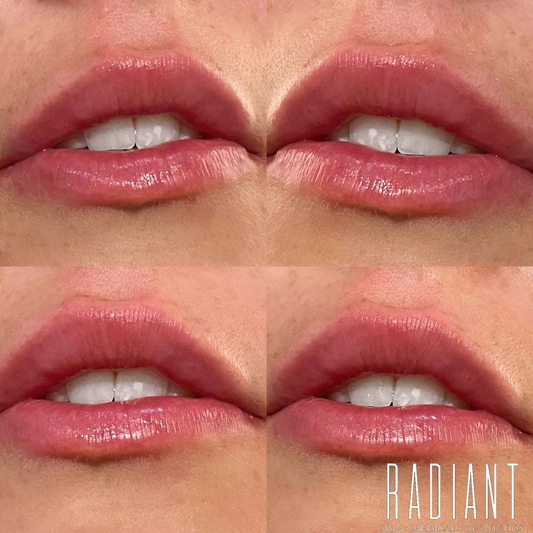Lip filler 2